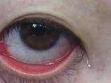眼の充血10