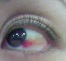 眼の充血4