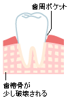 初期歯周炎（軽度）