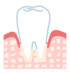 中期歯周炎（中程度）