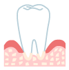 末期歯周炎（重度）